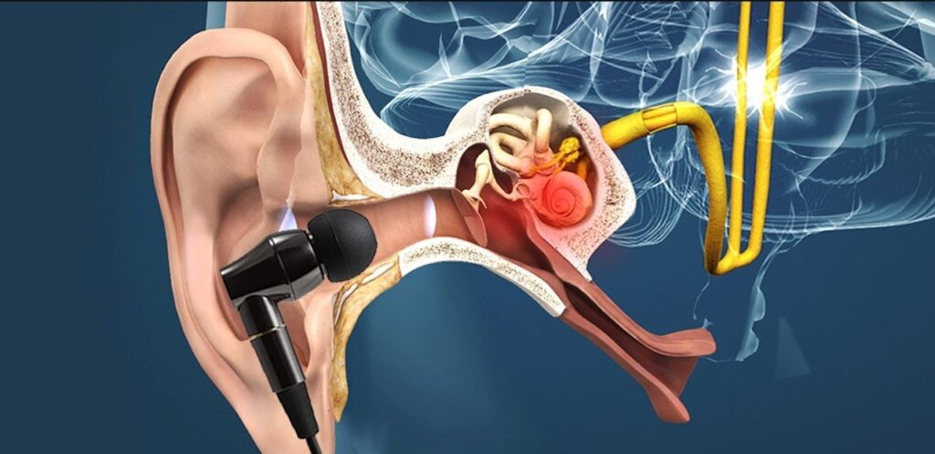 इयरबडले बहिरापन निम्त्याउनेबारे डब्लुएचओको चेतावनी, कति घण्टासम्म सुन्न सकिन्छ नियमित ?